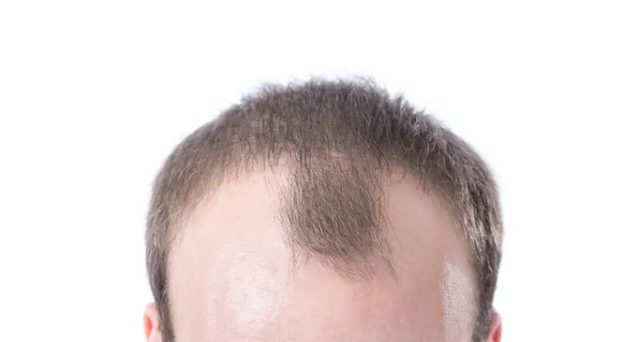 uneven receding hairline