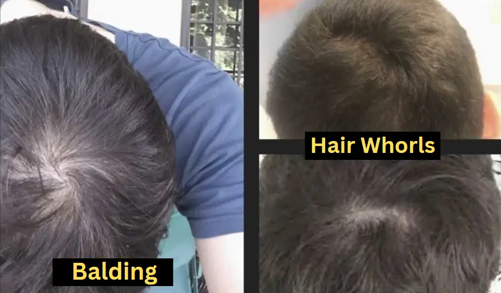 Hair Whorl or Balding
