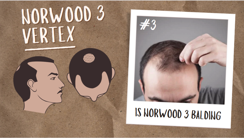 Norwood 3 Vertex: The Best Hair Loss Solution