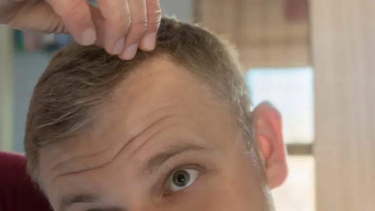 Receding Hairline Stages