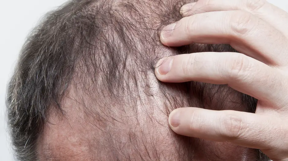 scalp visible through hair