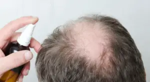 Can I Comb My Hair After Applying Minoxidil
