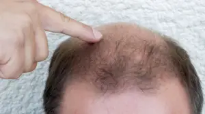 Crown of Head Balding