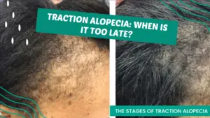Late Stage Traction Alopecia
