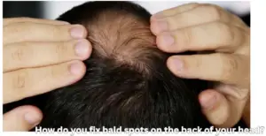 Back of Bald Head