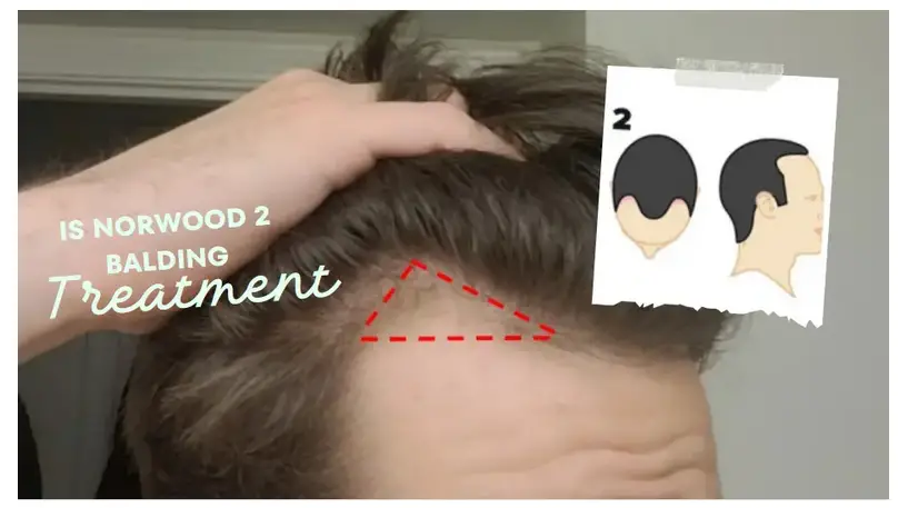 Illustration of Stage 2 Hair Loss