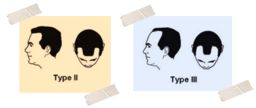 Stage 2 and Stage 3 Hair Loss