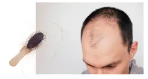Male Pattern Baldness Cure