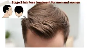 Stage 2 Hair Loss Treatment