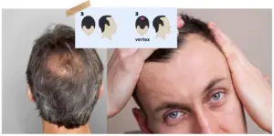 Stage 3 Hair Loss Treatment