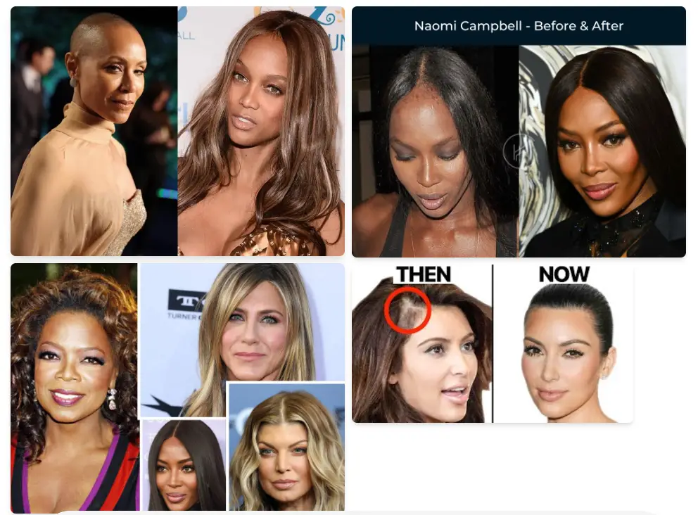Before and after hair transplant female celebrities 