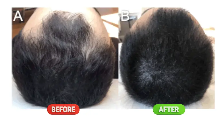 Redensyl Before and after image showing noticeable hair growth and increased hair density after 3 months of consistent use of a Redensyl product.