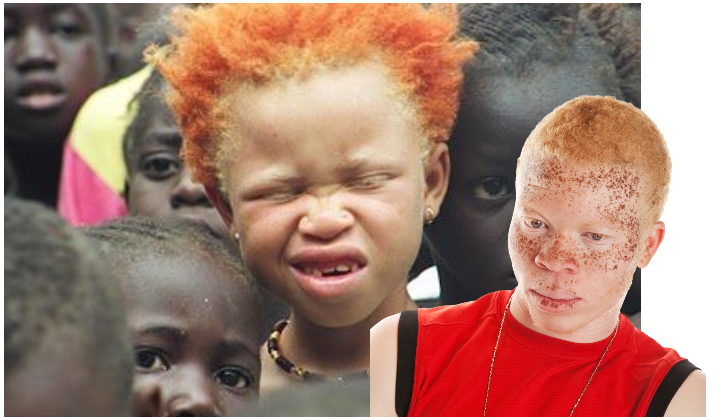 Albinism is a rare genetic condition that affects the production of melanin, the pigment that colors skin, hair, and eyes.