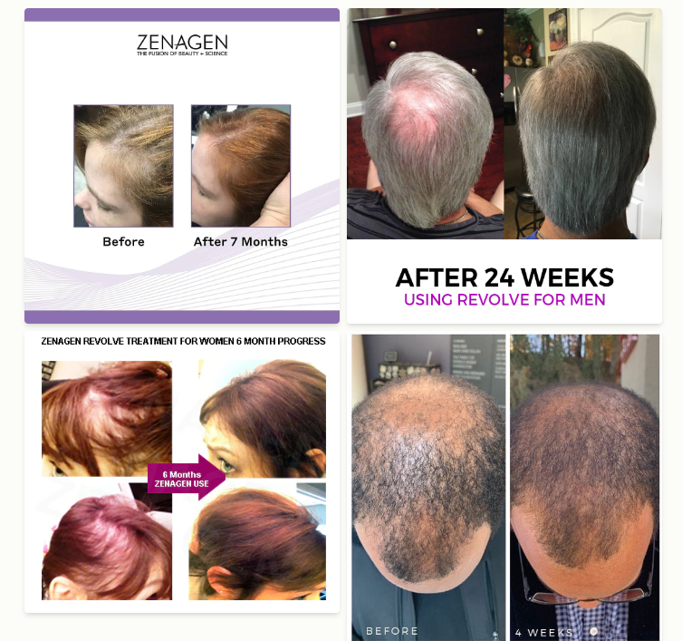 Zenagen Shampoo Before and After