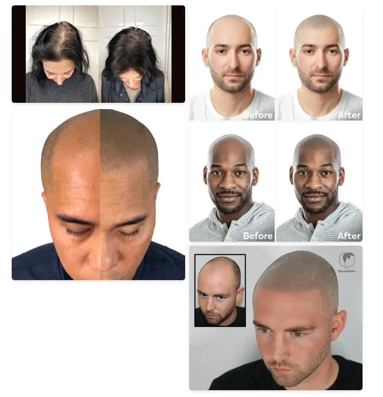 before and after scalp micropigmentation
