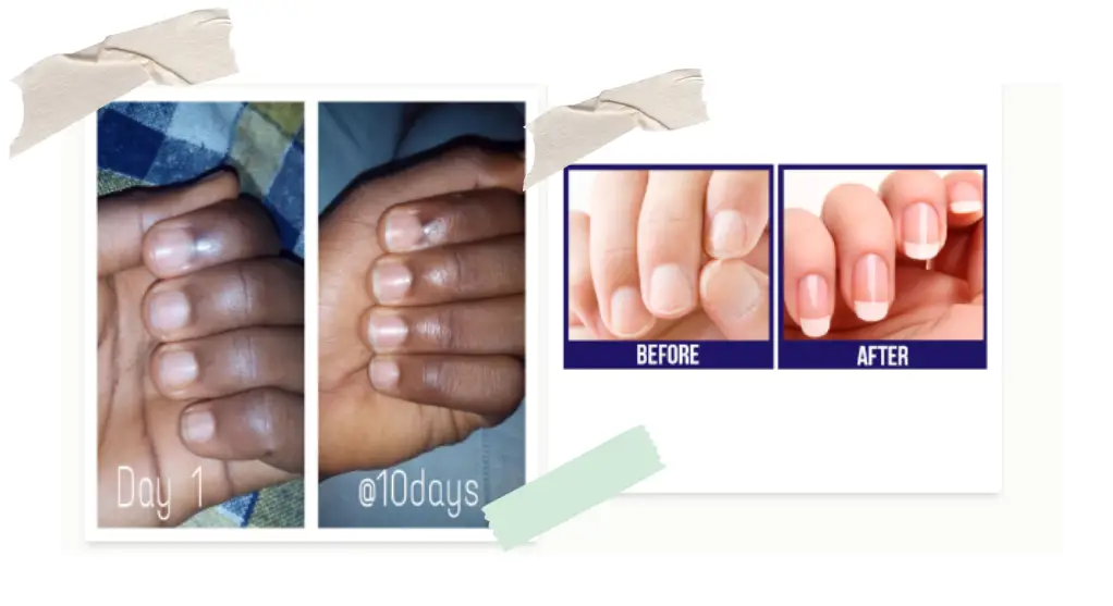 biotin before and after for nail growth