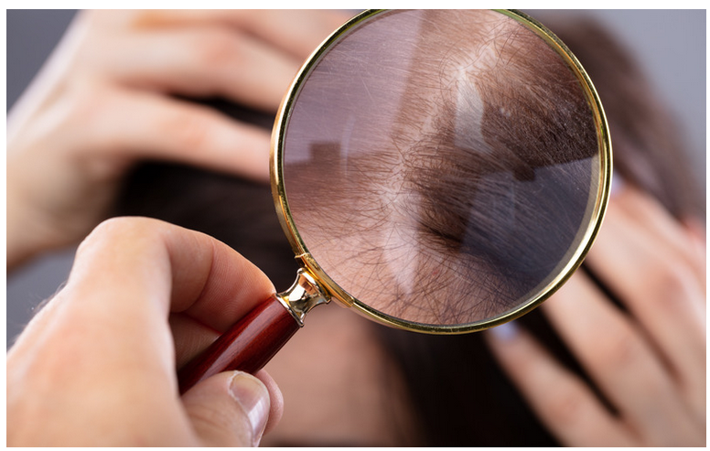 A magnifying glass over strands of hair, symbolizing the analysis of hair loss