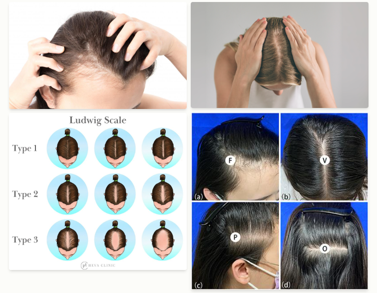 early stage of female hair loss