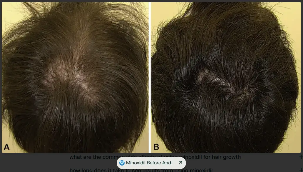 Before and After Effects of Using Minoxidil