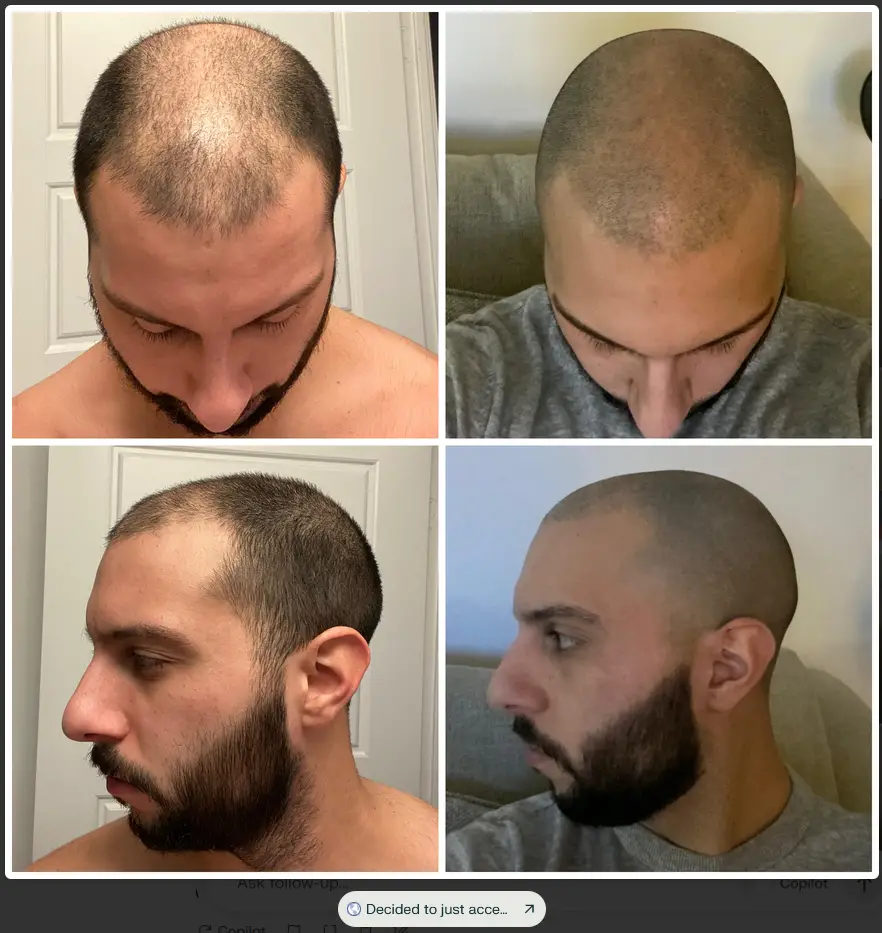 Buzz Cut Receding Hairline Before and After