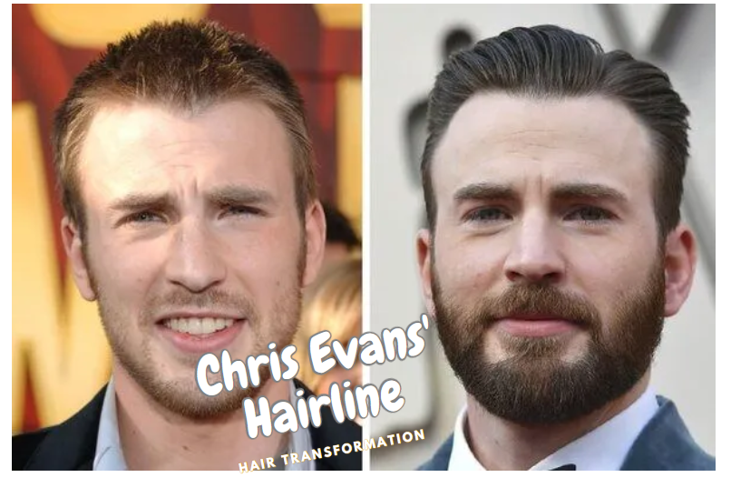 Chris Evans' hairline
