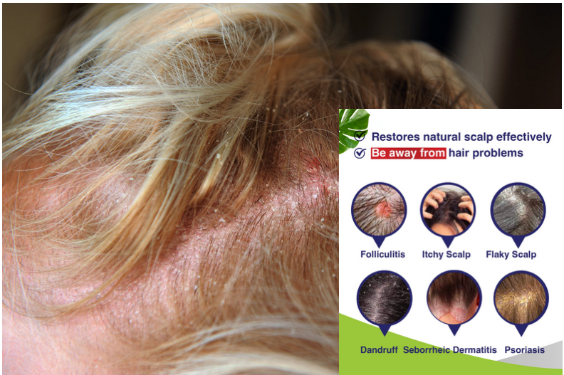 Hair Loss With Seborrheic Dermatitis Causes And Treatment Stages Of