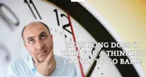 How Long Does It Take for a Thinning Crown to Go Bald