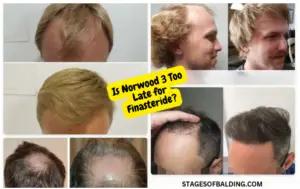 Is Norwood 3 Too Late for Finasteride