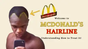 McDonald's Hairline