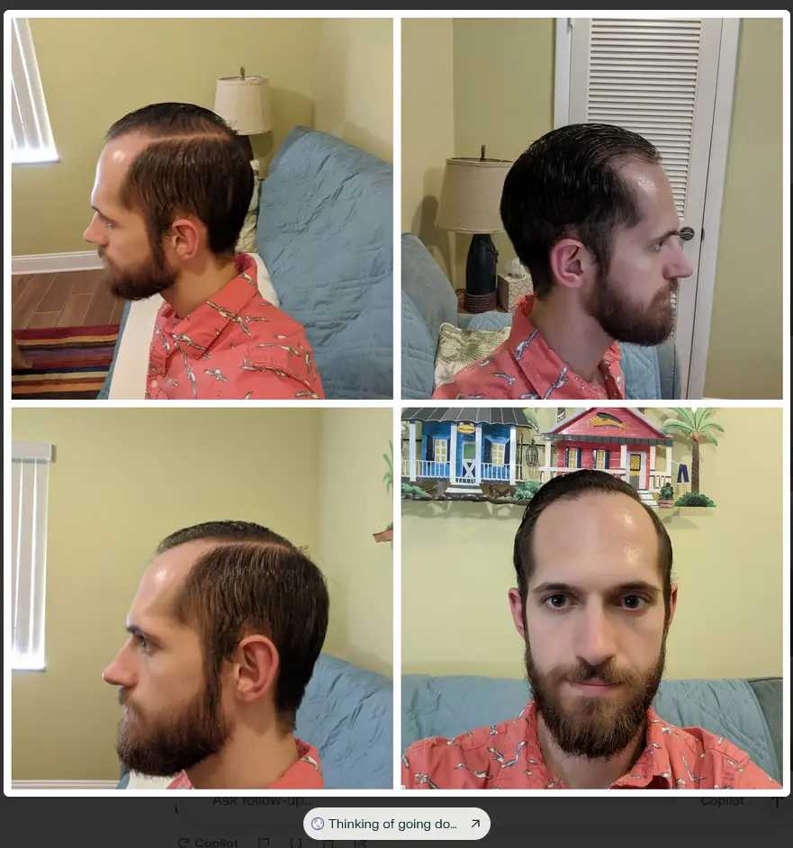 Receding Hairline Buzz Cut Before and After Pictures