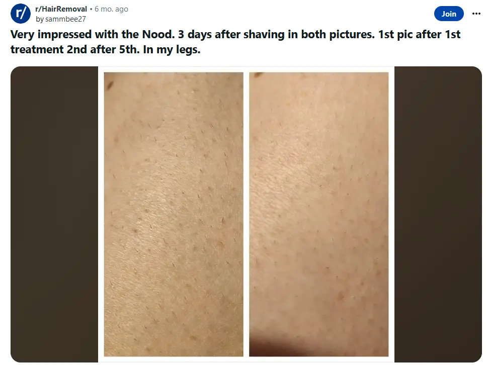Reddit User Reviews on Nood Hair Removal
