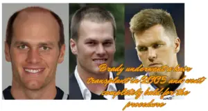 Tom Brady Bald