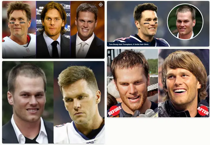 images that illustrate the various stages of Tom Brady's hair over the years, from his early career to the present day