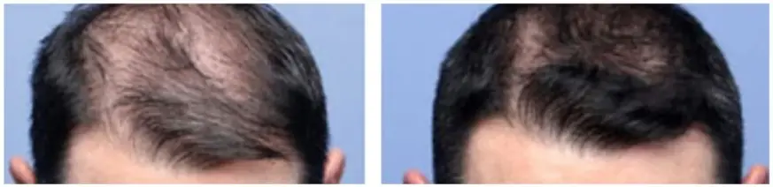 saw palmetto FOR HAIR LOSS Before and After Experiences