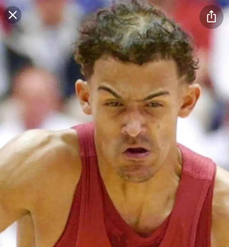Close-up image of Trae Young bald spot and unique hairline