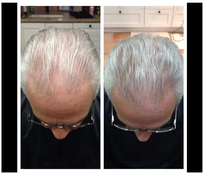 Treatment Options for Crown Balding