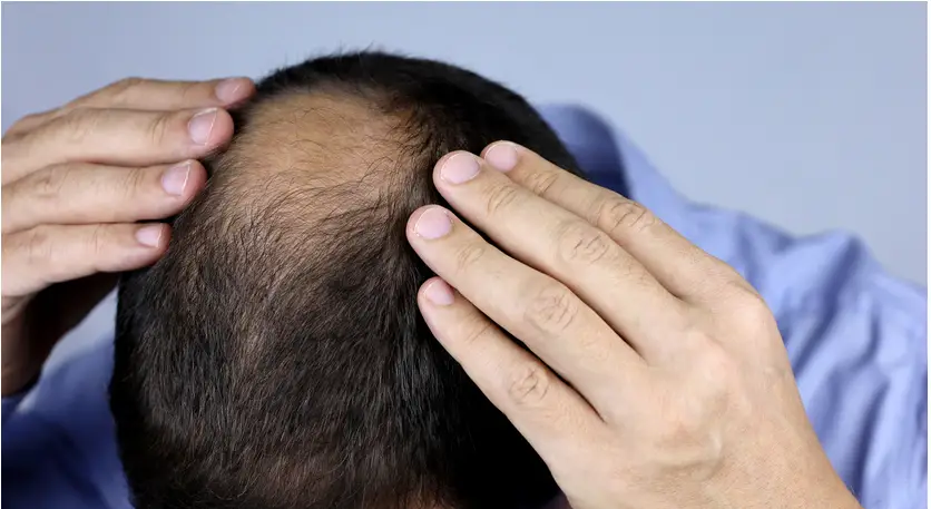 Causes balding