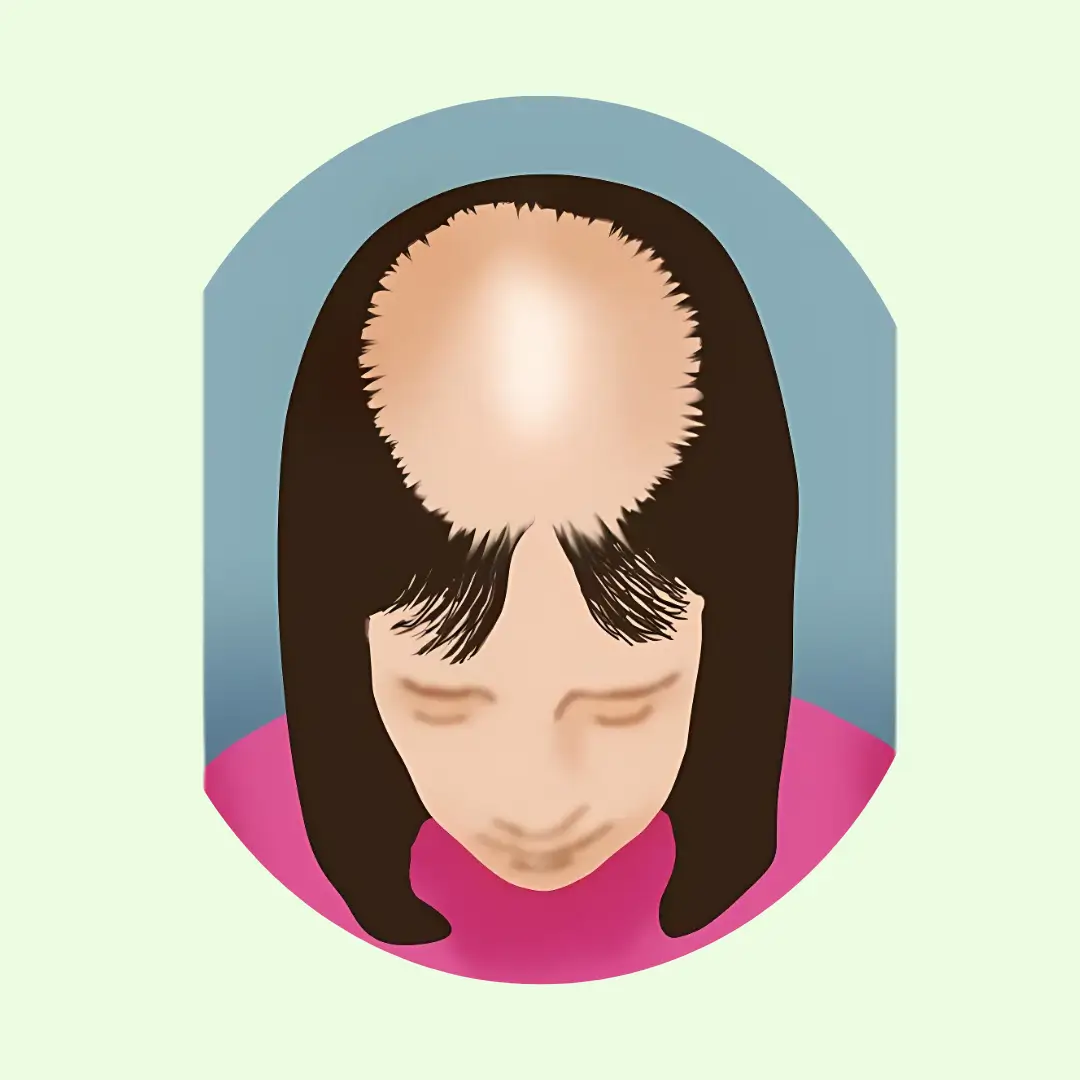 Advanced stage of hair loss in women