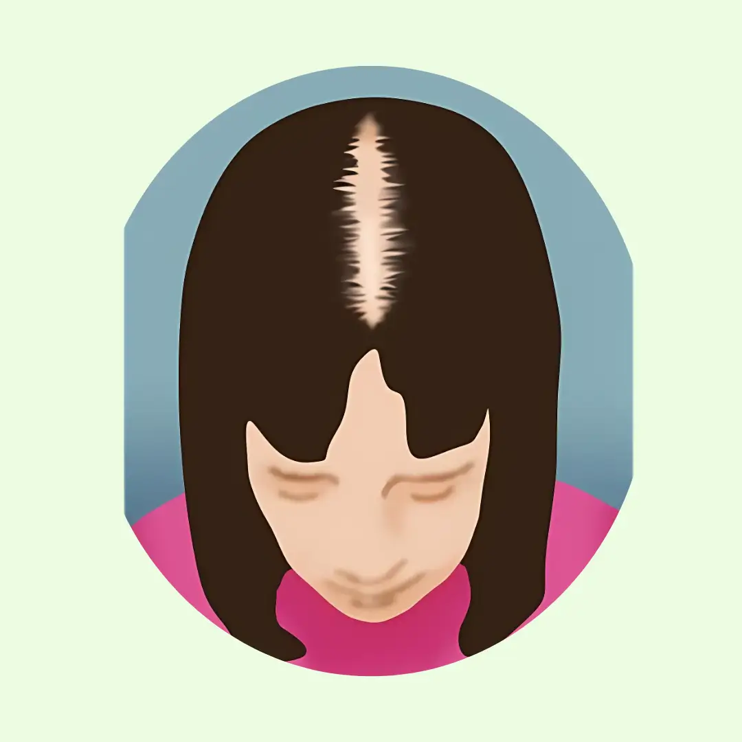 stage 1 hair loss in women