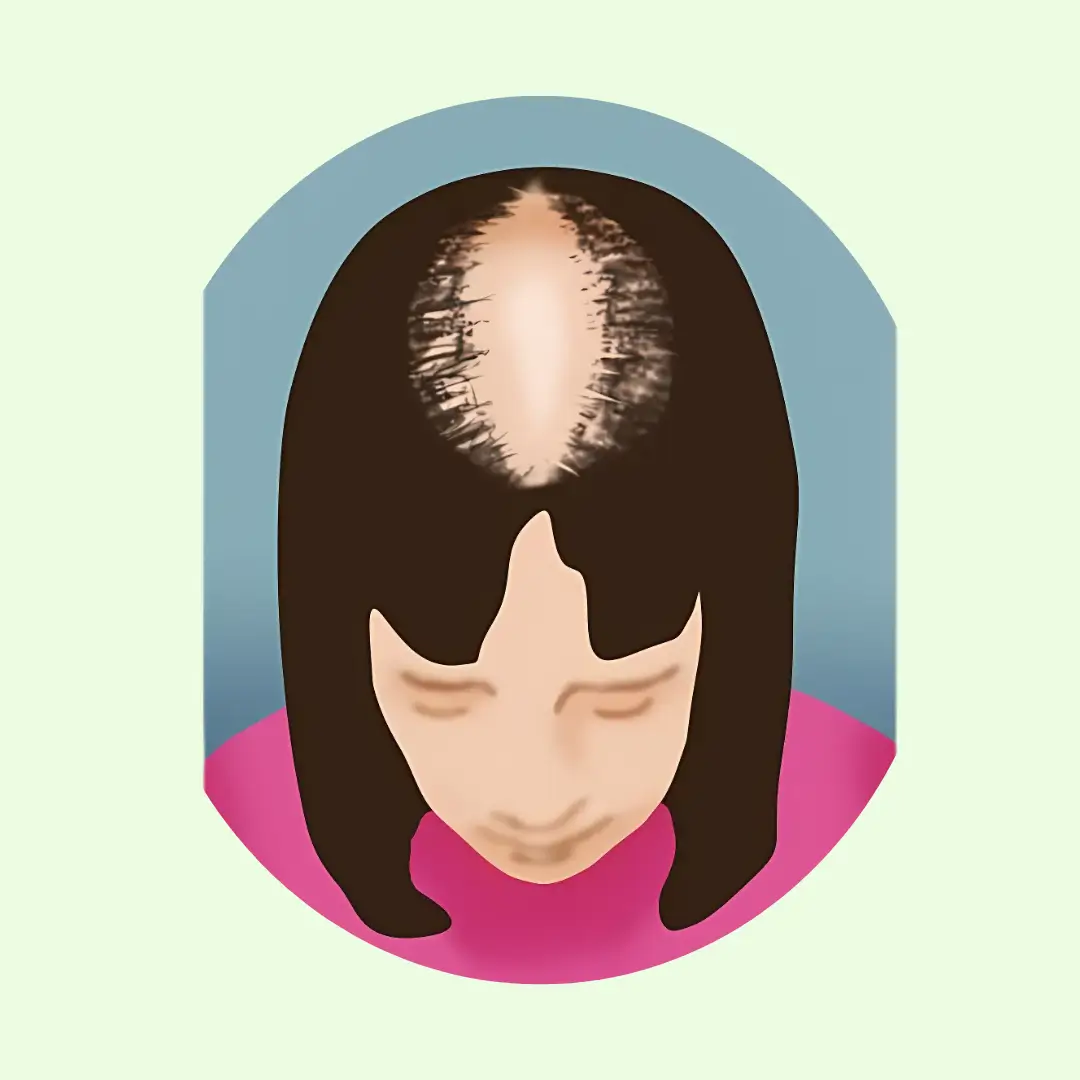 stage 2 hair loss in women