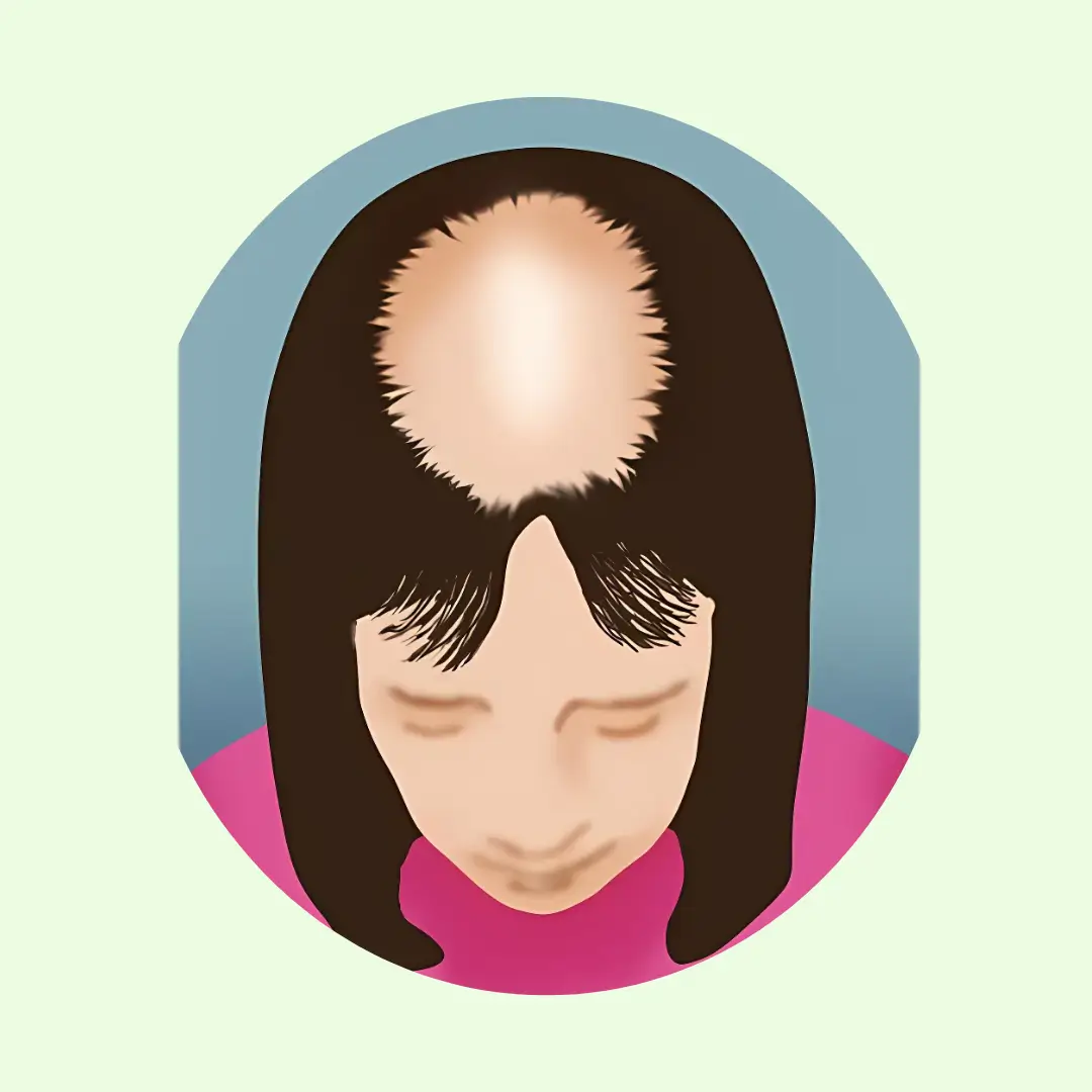 stage 3 hair loss in women-1